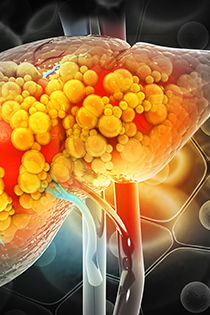 Targeting the Metabolic Processes of Nonalcoholic Steatohepatitis in Treatment Decisions Banner